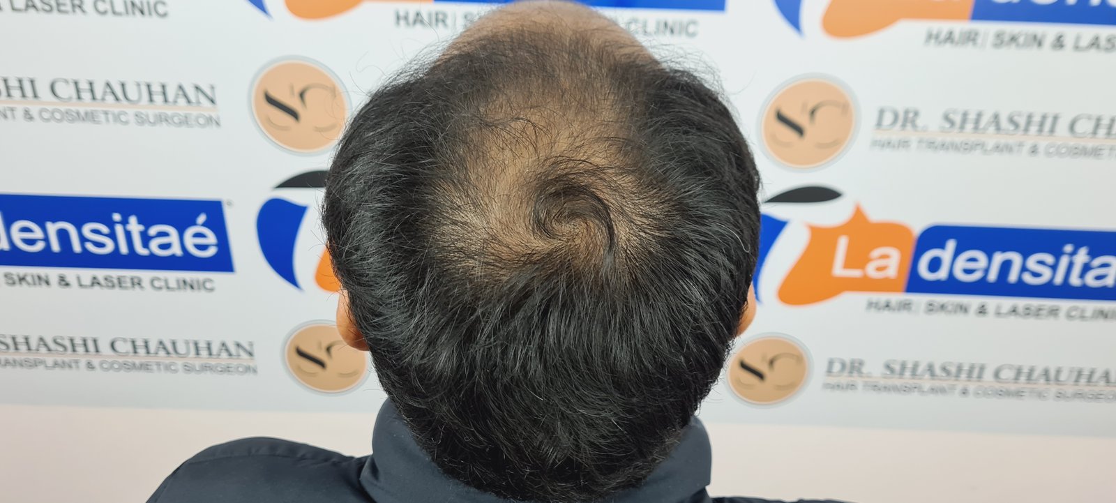 Anesh Kumar Before Hair Transplant